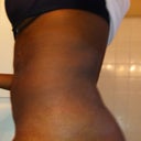 Day 2 post (side) Swollen & draining.