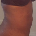 Day 6 post side