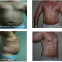My 4 week journey post Vaser Hi-Definition
