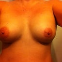 Post op day 1 front view