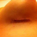 Right incision post op day 1 (I think this is the one u can see the suture in)