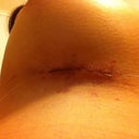 Left incision post op day 1