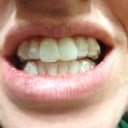 Before, Tray 1. GROSS - bottom teeth are crowded, 4 teeth need to be rotated, front teeth not in line with rest, large overbite, etc.