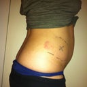 Before- right after procedure