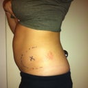Before- right after procedure