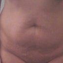 PRE OP