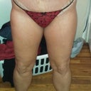 10 DAYS POST OP