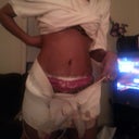 3 days post op