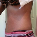 side view 5 weeks post op