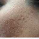 Stock photo of acne scars for reference only.