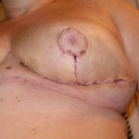 day 2 post op - leftie - scaring not that bad - shape, ugh-not so pretty right now...