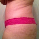 Left side 7 weeks