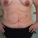 pre-op front view