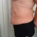 pre-op side view