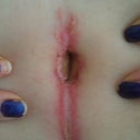post-op day 9...sores/rash caused my my stomach being folded together, "my butt in the front" :-(