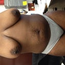 FRONT VIEW PRE OP