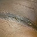close up of left side of my incision 4 day post op