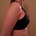 About 12 hours after surgery. These pics aren't great and the bra makes them look smaller than they do in real life, but it's the best I can do tonight. :)