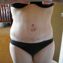 scar 2 wks po
