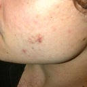 3 months post subcision. Hypertrohpic/Keloid scar from dr's procedure