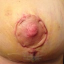 see how the skin edges are thick?? Will that even out as I continue to heal?!?