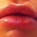 next morning! OUCH! Soooo swollen!
