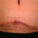 Post Op Day 54 A very small "hole" has opened up and feeling some of the dissolvable stitches poking through the front center of the incision - not long enough for me to trim with scissors.