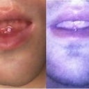 1wk & 3wks post surgery