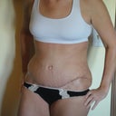 16 days Post OP