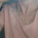 chest scar