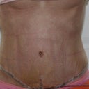 One week post-op--a little more bruised and swollen