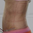 One week post-op--you can see all the marks from the binder