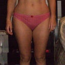 Pre Surgery Front