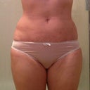 1 Week Post Surgery - Flanks ( front view)
