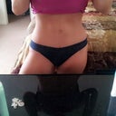 Scar is below the pantie line so happy about that