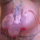 post op 3 days after shower 3 drains in