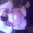 post op 1 week