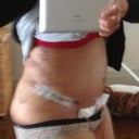 Post op day 4- side view
