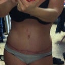 7 weeks PO. Still have swelling in my hips...