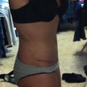 7 weeks PO. Left side.