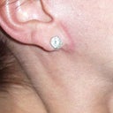 Pixie ear deformity LL caused plus ropey scarring. Both sides are the same. $16,500 to correct this.