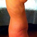 Left side at 9 weeks post op