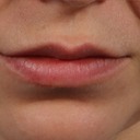 Removal Of Lip Nevus