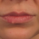Removal Of Lip Nevus