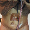 2 days out and very swollen. But the dr. got all of my love handles and back fat.