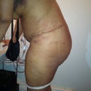 Day 2 side view. Very swollen but I know once it goes down its gonna look great
