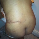 Day 2 my backside. Sorry about the butt shot but my back looks good. Very swollen. Full of fluid. But no more flaps of fat at the bra line