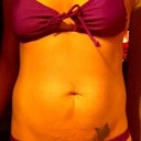 1 week pre op