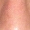 After Dr. Hossam Foda surgery. See graft on septum merging siudeways and large hanging columalla.