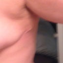 Dog ear/uneven scar that is getting corrected with scar revision surgery.
